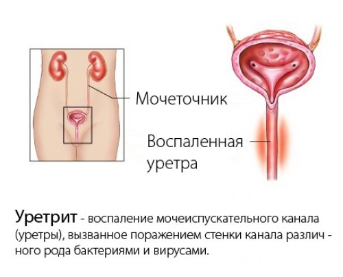 Инстилляция при уретрите