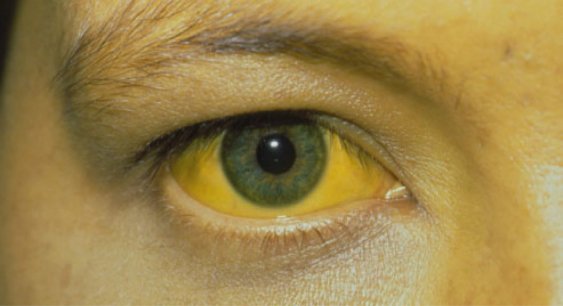 желтушность склер глаз