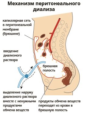 Перитонеальный диализ