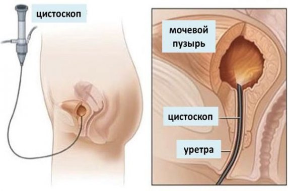 цистоскопия у женщин